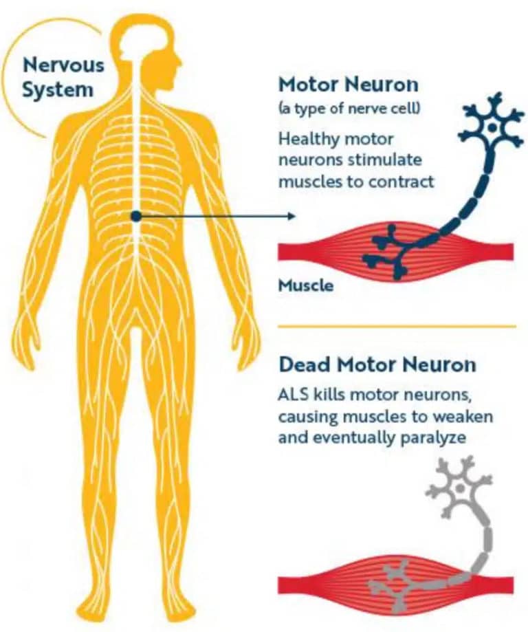 Understanding ALS: A Comprehensive Guide | ALS United Chicago